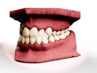 Zahnfehlstellungen bei Erwachsene » NOKZEIT